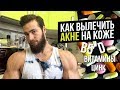 Как избавиться от Прыщей НАВСЕГДА? (Лечение АКНЕ, Черных точек)