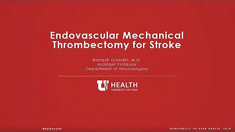 Endovascular Mechanical Thrombectomy for Stroke