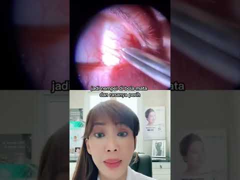 Video: Cara Mengeluarkan Syampu dari Mata Anda: 14 Langkah (dengan Gambar)