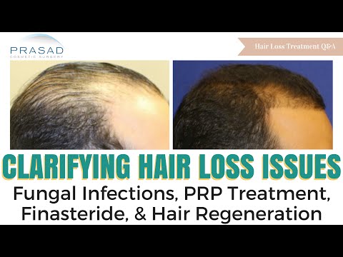 Hair Loss Issues - Fungal Infections, and Options When PRP and Finasteride Don't Work for You