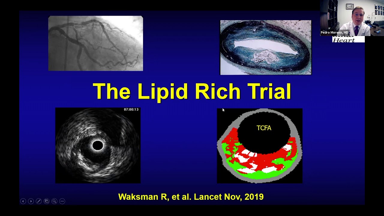 Vulnerable Plaque: Evolving Concepts - Dr. Pedro Moreno