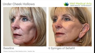 Treat Hollow Cheeks with Dermal Fillers using Bellafill.