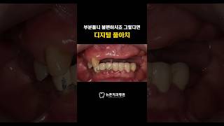 [부산전체임플란트] 불편한 부분틀니, 그렇다면 디지털 풀아치 #임플란트수술