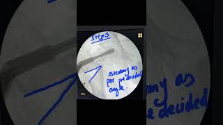 valgifying IT osteotomy for a patient who wanted to preserve his hip