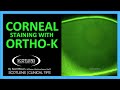 Scotlens series  topography tips  orthok corneal staining