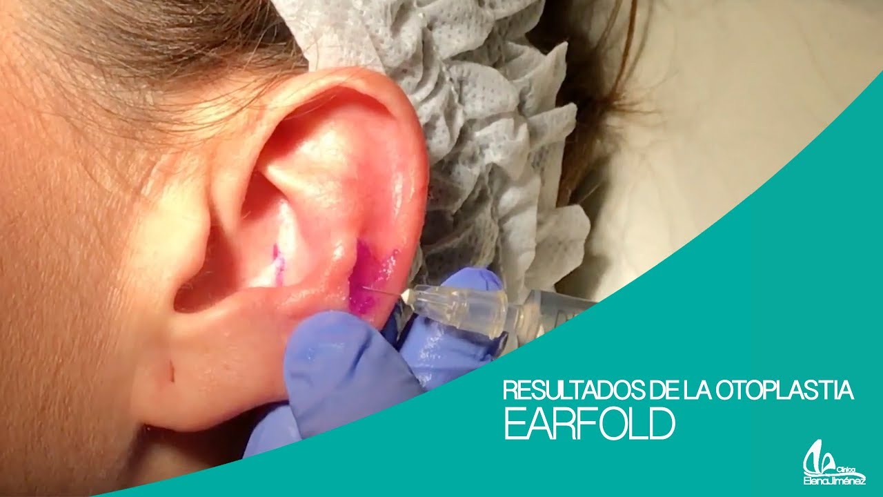 EarFold Madrid: Otoplastia, Corregir las orejas de soplillo | Clínica Elena Jiménez otoplastia popayan