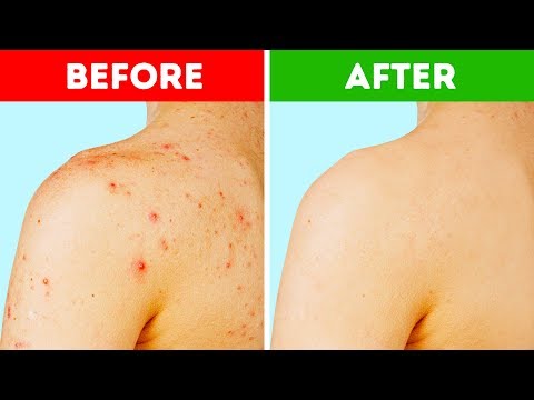 Video: 5 Life Hacks, Um Ihre Psoriasis Unter Kontrolle Zu Bringen