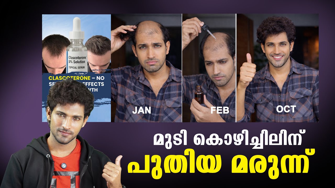 കഷണ്ടിക്ക് പുതിയ മരുന്ന് , ഫേസ് 3 പരീക്ഷണവും വിജയത്തിയിലേക്ക് | New treatment for Baldness