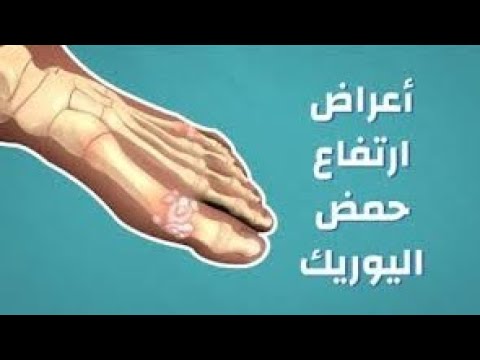 اعراض زيادة حمض اليوريك