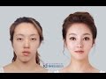 Double Jaw Surgery Asymmetrical Face, Korea Plastic Surgery  Let Me In TV Show,