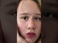 убираю прищи с помощью волшебного шарика