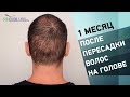 Пересадка волос на голове. Результат 1 месяц после операции по пересадке волос на голове в Турции