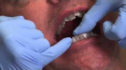 USAGE TIP 1 - ClearPath Aligner Insertion