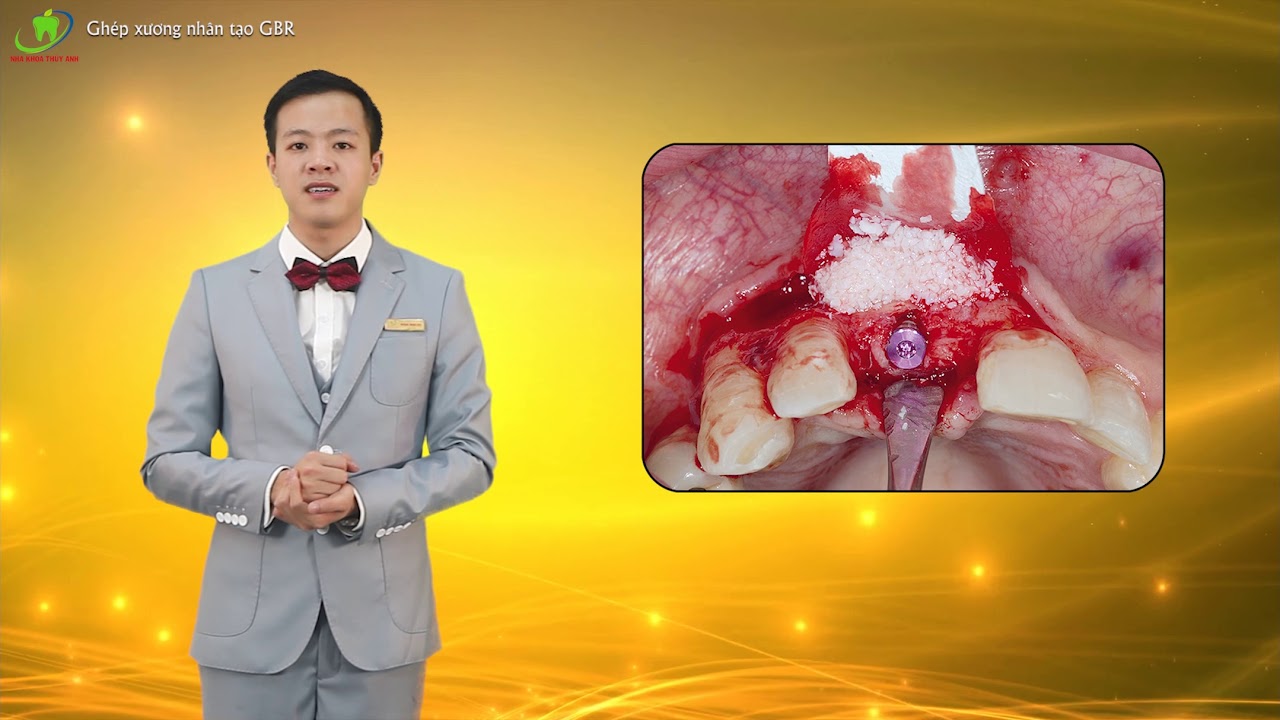 Outline Video Trả lời thắc mắc về ghép xương trong cấy ghép Implant