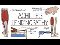 Understanding Achilles Tendinopathy (Achilles Tendinitis)