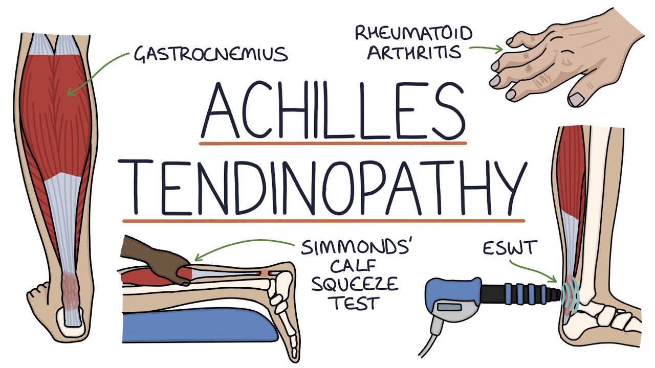 Understanding Achilles Tendinopathy (Achilles Tendinitis) - YouTube