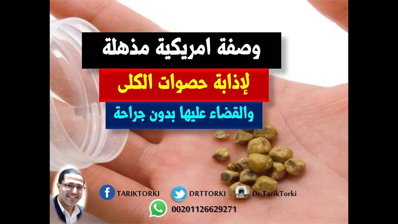 وصفة أمريكية رائعة لتذويب وإزالة حصوات الكلى بدون جراحة