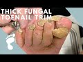 A Thick and Fungal Toenail!