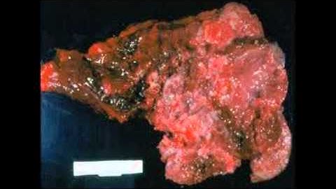 Radon: An Invisible Killer