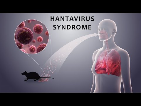 Hantavirus Syndrome