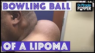 The Mother of all Lipomas Part 1 2, edited version