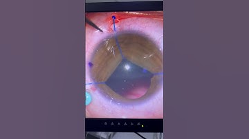 Yamane.  Using Y hook to help with Iris hooking