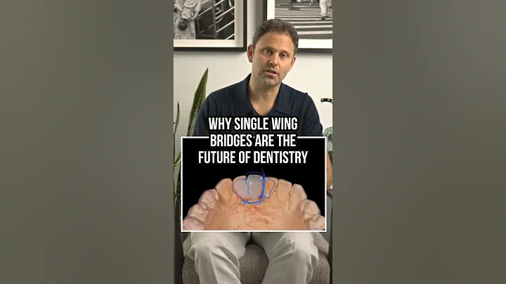 Why Single Wing Bridges Are the Future of Dentistry!