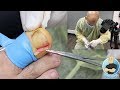 FIRST PERSON INGROWN TOENAIL REMOVAL