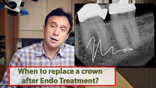 Quick Tip When To Replace The Crown After Endo