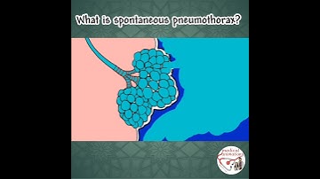 PNEUMOTHORAX