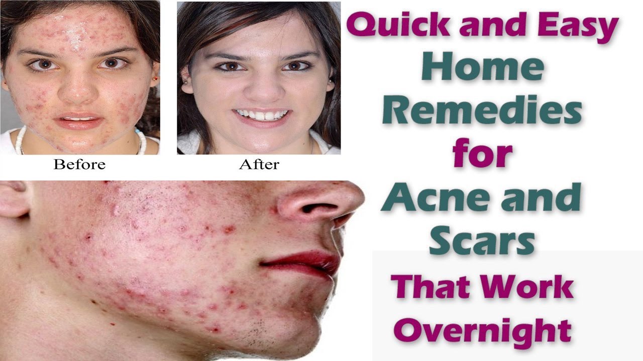 How To Get Clear Skin Remove Acne Scars Pimples At Home Naturally