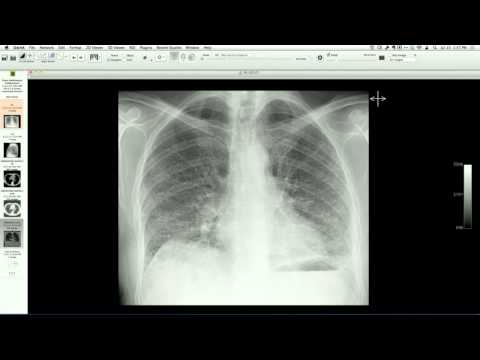 Granulomatosis with Polyangiitis
