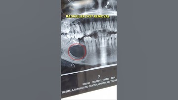 Radicular Cyst : Cyst in Lower Jaw | Removal of Jaw Cyst by Maxillofacial Surgeon