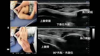 肩関節の超音波解剖③(烏口上腕靭帯：CHL)