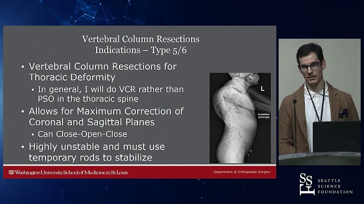 Osteotomies in Spinal Deformity - Michael P. Kelly...