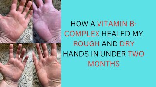 HOW A VITAMIN B- COMPLEX HEALED MY ROUGH AND DRY HANDS IN UNDER TWO MONTHS