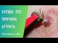 Клещи и ревматоидный артрит. Как проверить себя #анализы