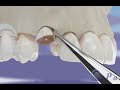 दांत प्रत्यारोपण हेतु हड्डियों मे परिवर्तन (bone grafting) ©