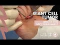 Giant Cell Tumor