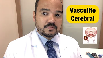 O que pode causar vasculite cerebral?