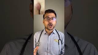 What is Pilonidal sinus Causes, prevention, surgery and treatment of pilonidal sinus by Dr Animesh