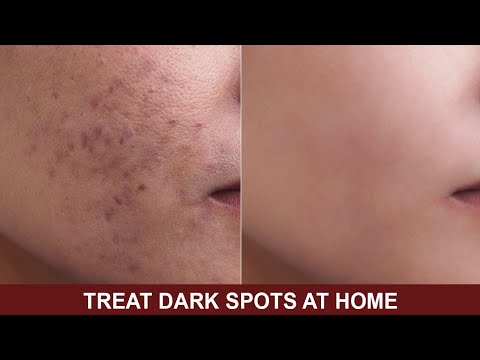 Home made DIY Anti-pigmentation Face Pack | DIY Skin Toner | DIY Skin Whitening Face Serum