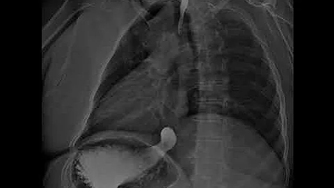Dynamic Digital Radiology View of Esophagus: Esophagogastroduodenoscopy (SEGD Test) part 6