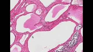 Histopathology Neck--Lymphangioma (cystic hygroma)