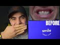 I TRIED SMILE DIRECT CLUB FOR 6 MONTHS! (And This is What Happened)