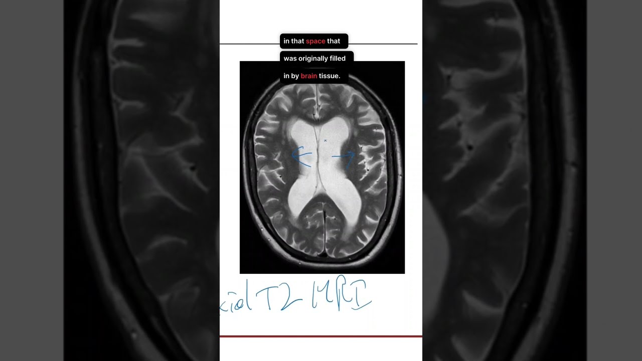 Hydrocephalus Ex Vacuo on Brain MRI