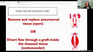 Michol Copper MD, PhD - Abdominal Aortic Aneurysm Lecture screenshot 2