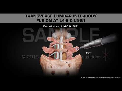 Transverse Lumbar Interbody Fusion at L4-5 & L5-S1 - Medical Animation