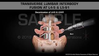 Transverse Lumbar Interbody Fusion at L4-5 & L5-S1 - Medical Animation