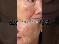 주름과 기미잡티가 많으면 이거 필수입니다#화장품 #피부 #안티에이징 #주름개선 #기미잡티 #노화방지 #검버섯 #beauty #피부좋아지는법 #퓨어라이트